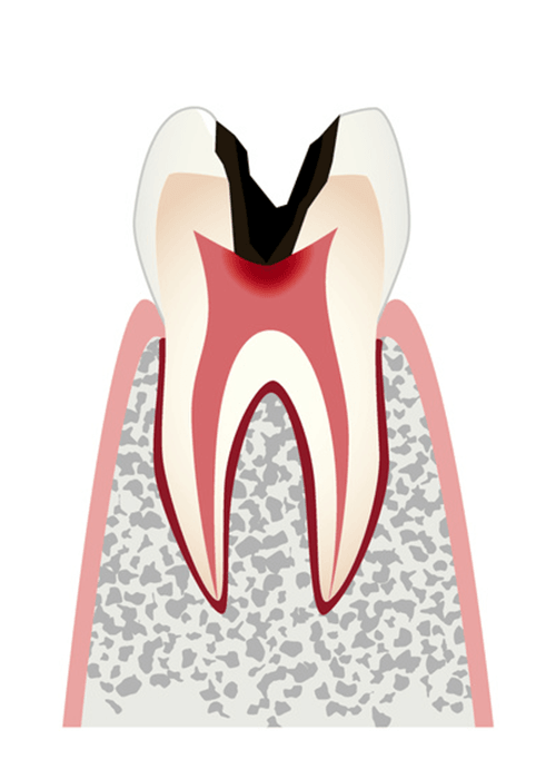 神経まで進行したむし歯