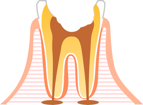 むし歯・神経の除去