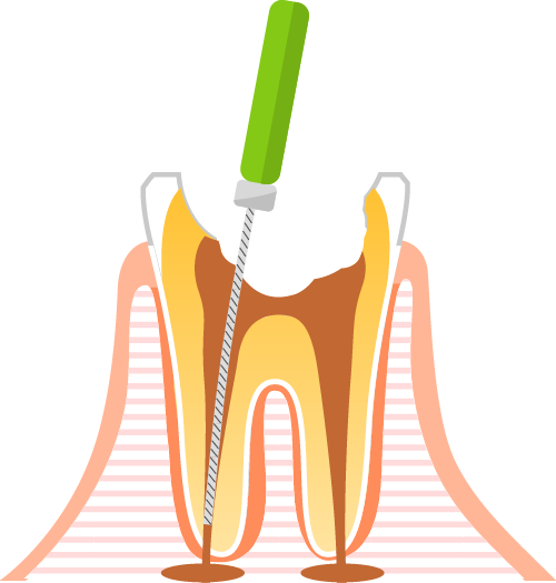 根管を拡大