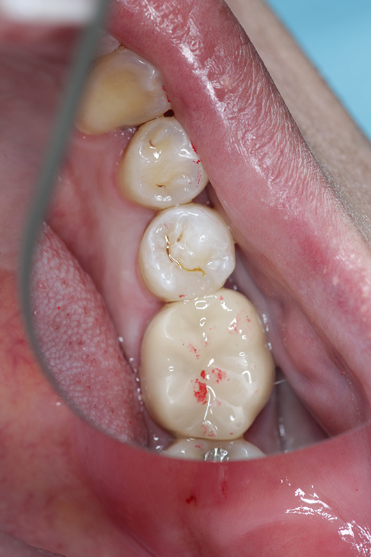 ダイレクトボンディング治療　治療後