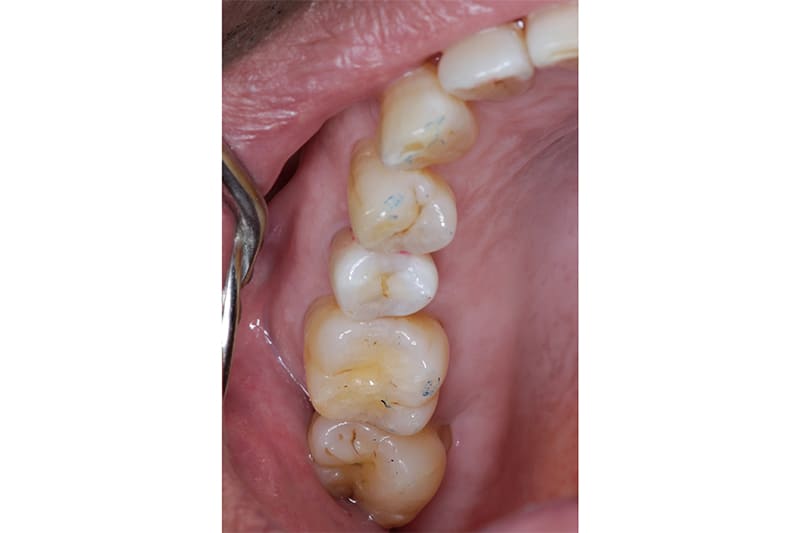 根管治療後のダイレクトボンディング治療　治療後