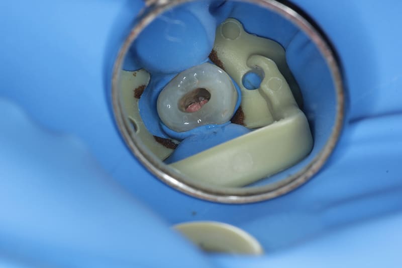 根管治療後のダイレクトボンディング治療 治療前