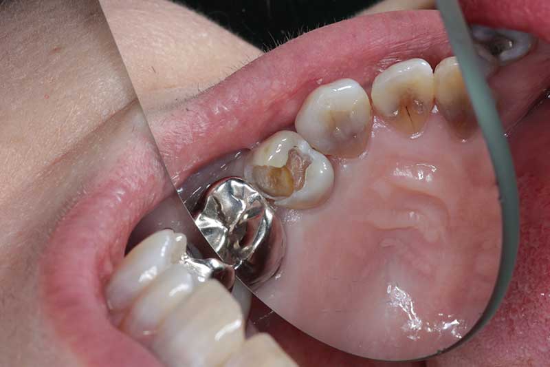 ダイレクトボンディング治療 治療経過