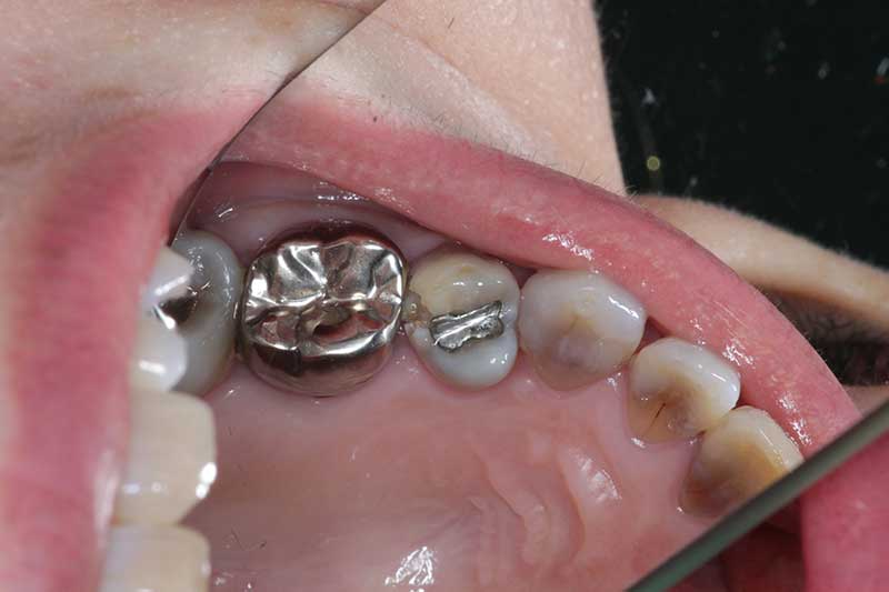 ダイレクトボンディング治療 治療前