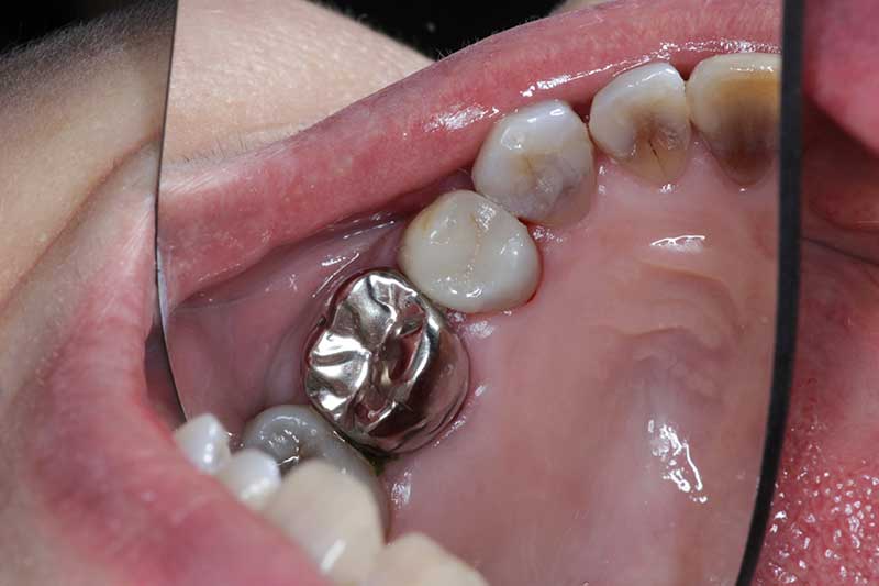 ダイレクトボンディング治療 治療後