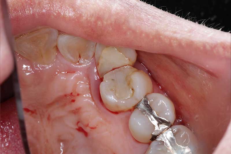 ダイレクトボンディング治療 治療前