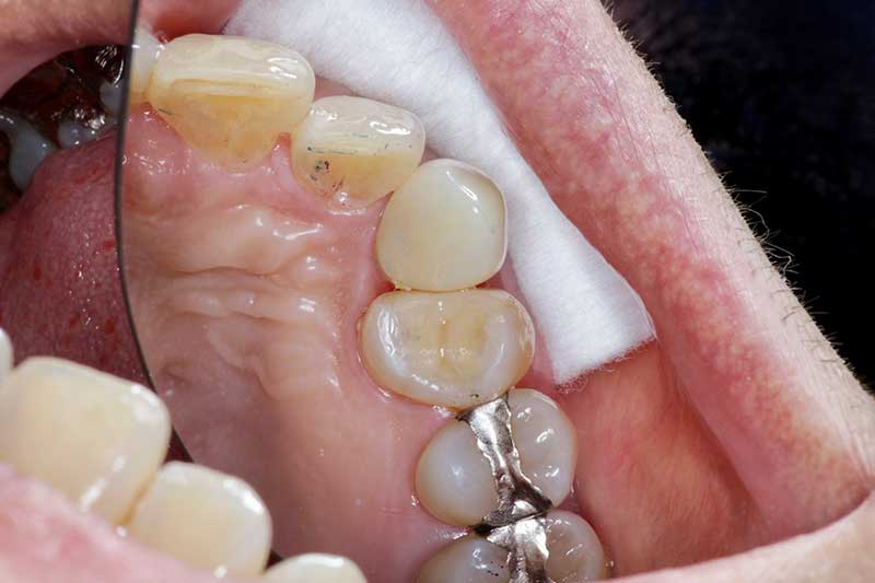 ダイレクトボンディング治療 治療後