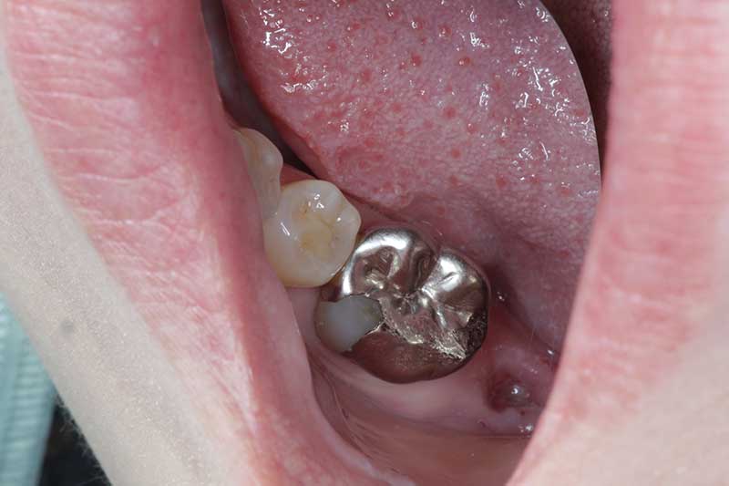 ダイレクトボンディング治療 治療前