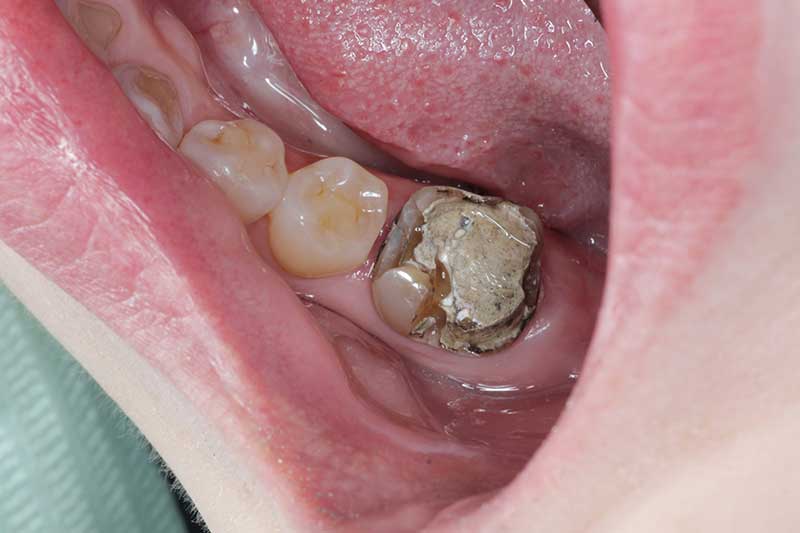 ダイレクトボンディング治療 治療経過