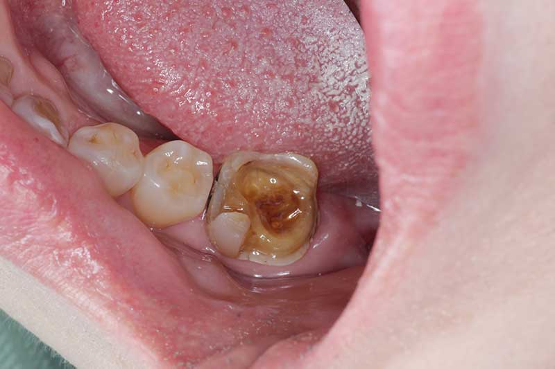 ダイレクトボンディング治療 治療経過