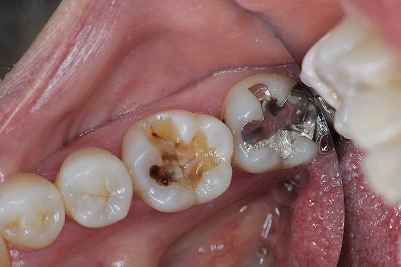 ダイレクトボンディング治療 治療前