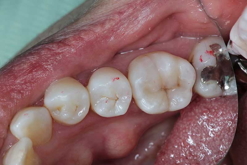 ダイレクトボンディング治療 治療後