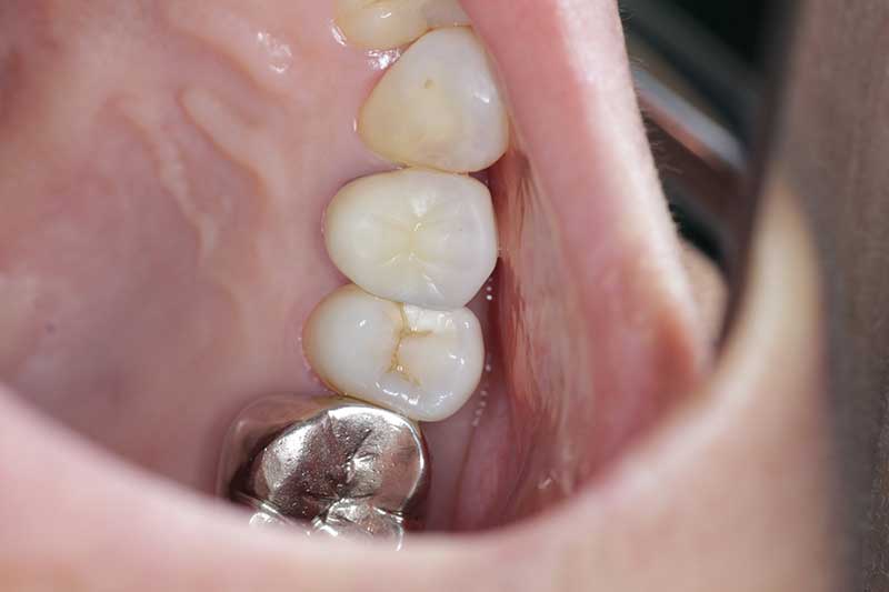 ダイレクトボンディング治療 治療前