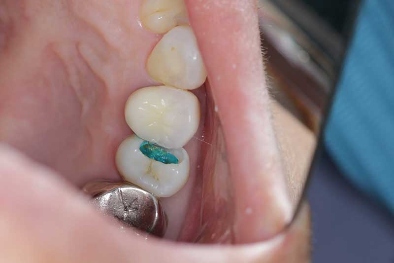 ダイレクトボンディング治療 治療経過