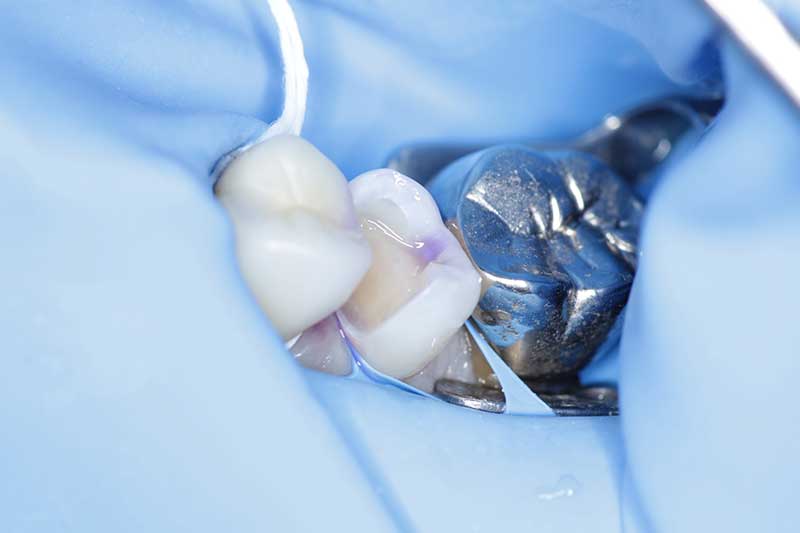 ダイレクトボンディング治療 治療経過