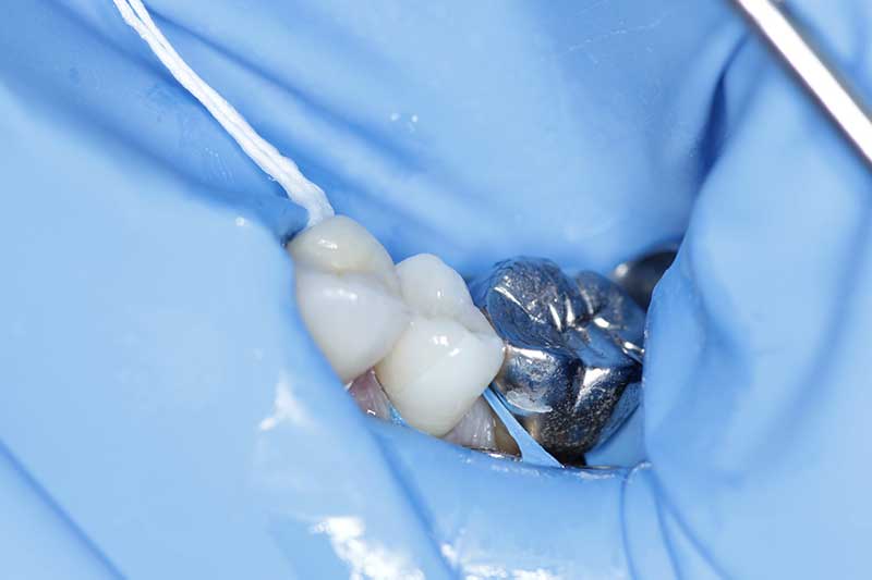 ダイレクトボンディング治療 治療経過