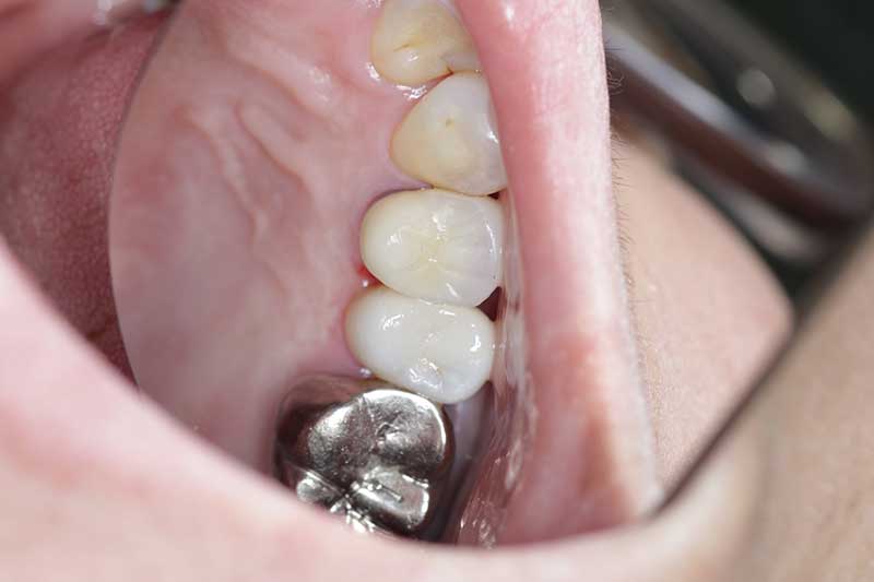 ダイレクトボンディング治療 治療後