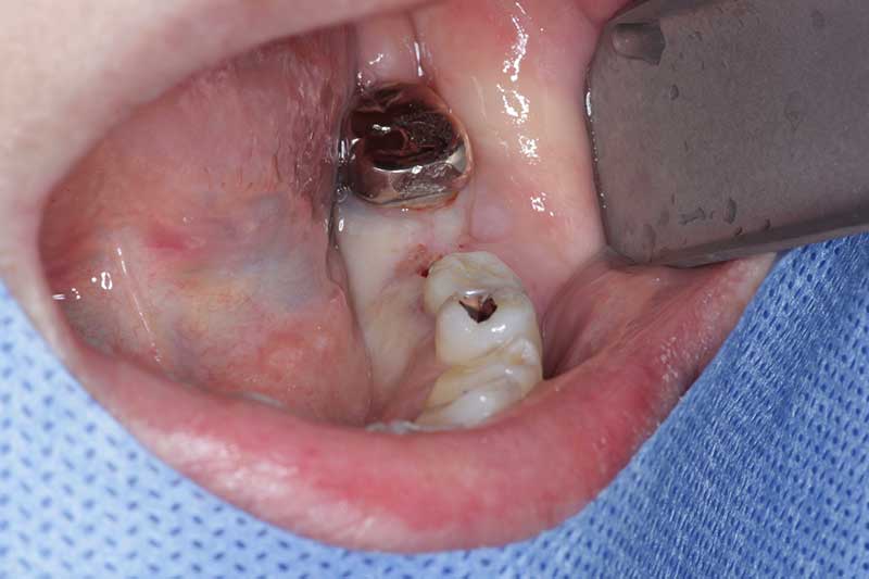 インプラントの症例 治療前