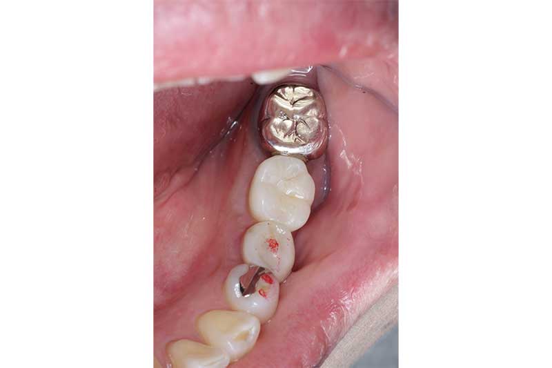 インプラントの症例 治療後