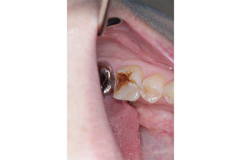 大臼歯のジルコニアクラウンの症例 治療前