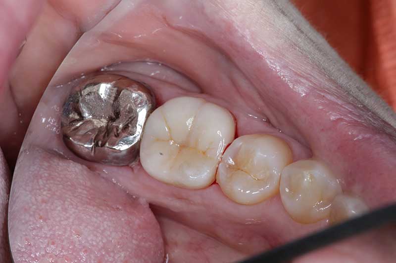 大臼歯のジルコニアクラウンの症例 治療後