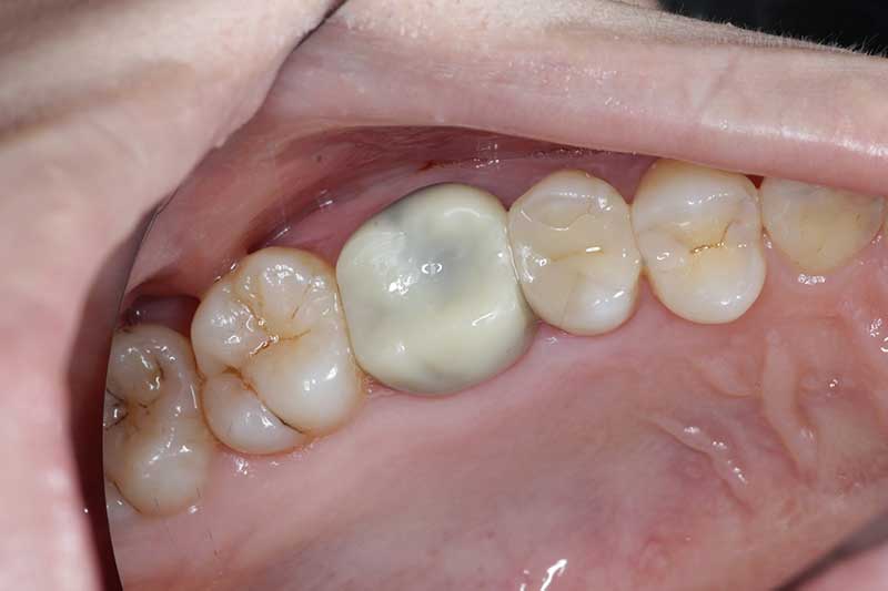 大臼歯のジルコニアクラウンの症例 治療前