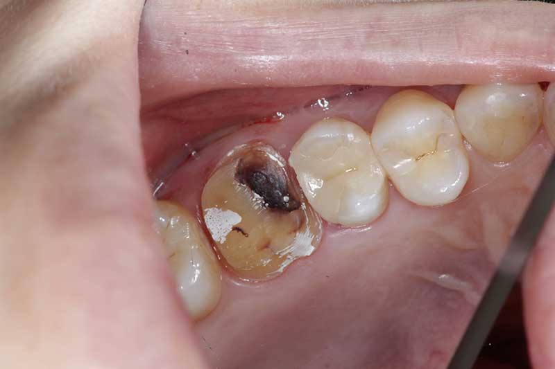 大臼歯のジルコニアクラウンの症例 治療経過