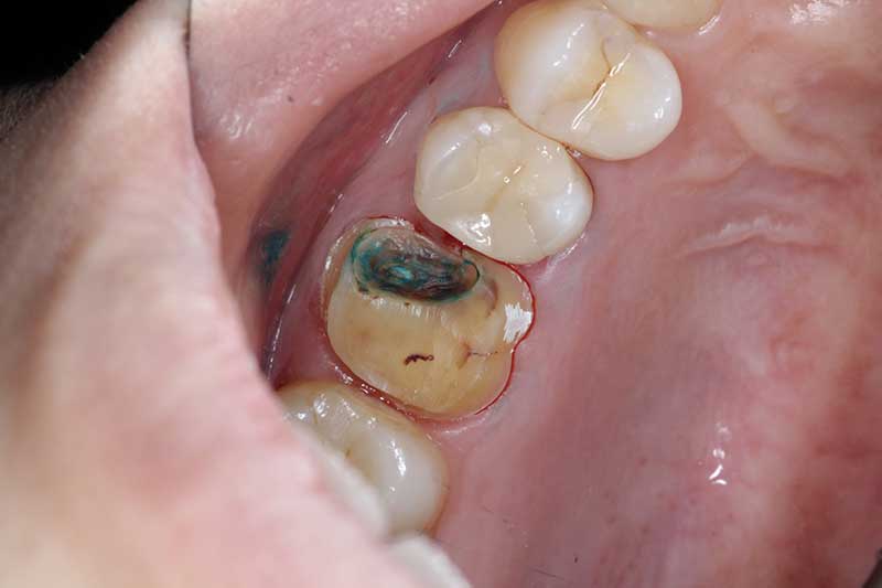 大臼歯のジルコニアクラウンの症例 治療経過