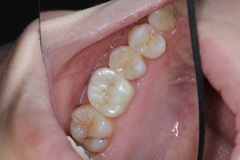 大臼歯のジルコニアクラウンの症例 治療後