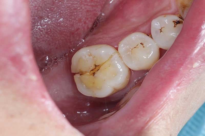 インプラントの症例 治療前