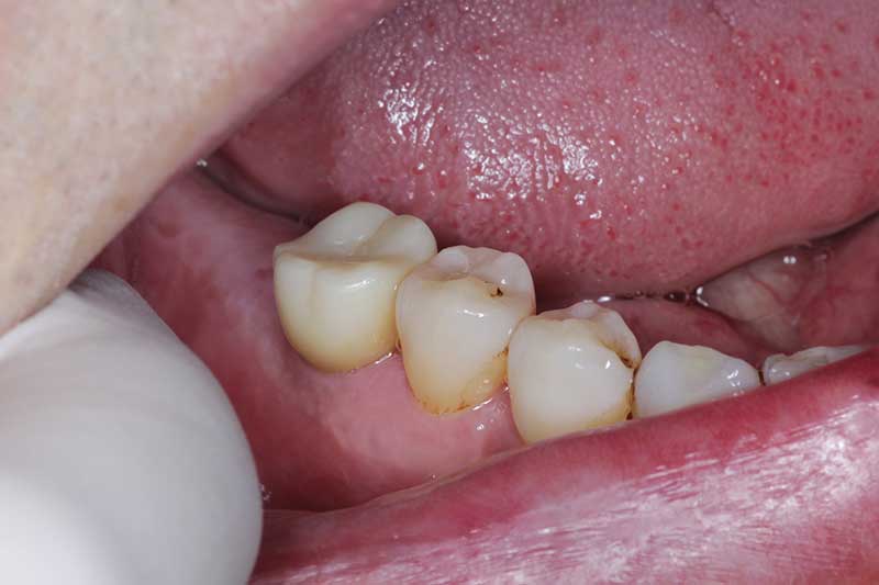 インプラントの症例 治療後