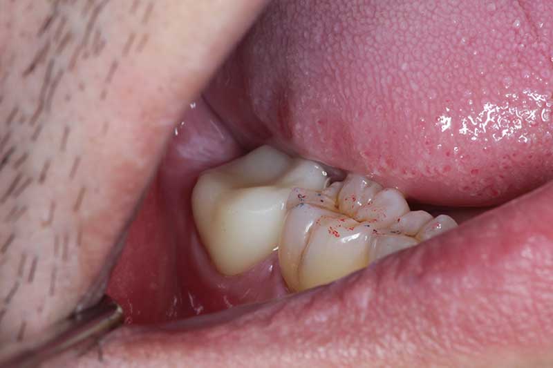 自家歯牙移植の症例 治療後